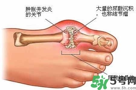 引發(fā)痛風(fēng)的原因是什么？痛風(fēng)病人飲食需注意什么好？