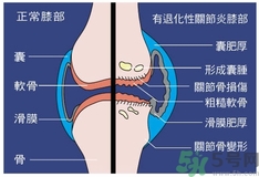 骨關(guān)節(jié)炎能治好嗎？骨關(guān)節(jié)炎平時(shí)注意事項(xiàng)