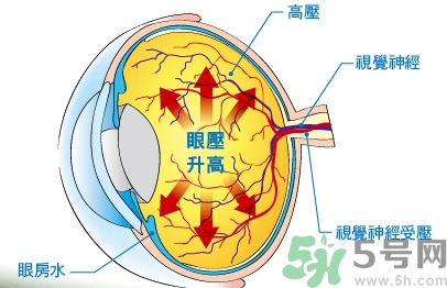 青光眼可以治愈嗎？青光眼怎樣治療？