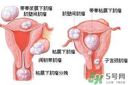 子宮小會影響生育嗎？子宮小會導致不孕嗎？