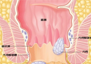怎樣辨別外痔和內(nèi)痔？外痔和內(nèi)痔的區(qū)別