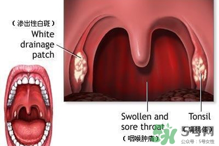 口含大蒜能治療咽炎嗎？巧用大蒜治療咽炎咳嗽