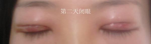 三點(diǎn)雙眼皮恢復(fù)過(guò)程圖_韓式三點(diǎn)雙眼皮多久恢復(fù)自然