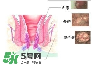 痔瘡吃什么藥效果好？痔瘡吃什么藥好得快？