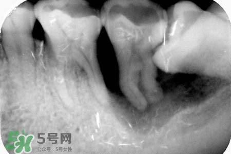 智齒會(huì)引起耳鳴嗎？耳鳴跟智齒有關(guān)系嗎？