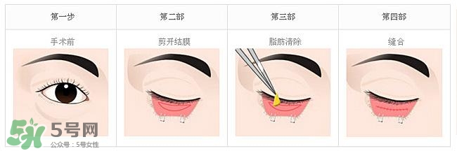 眼袋是怎么形成的？手術(shù)去眼袋安全嗎