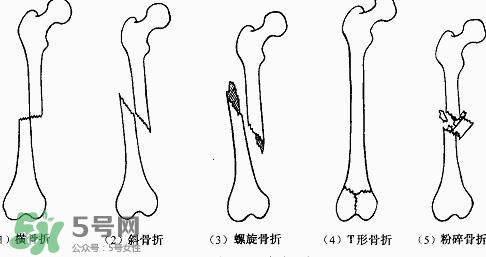 骨折吃什么好得快？骨折后注意事項(xiàng)