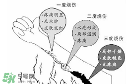 燙傷起泡要挑破嗎？燙傷起泡怎么處理？