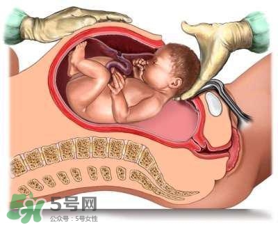 剖腹產的過程 剖腹產的步驟及時間