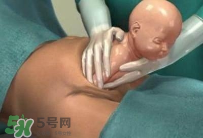 剖腹產的過程 剖腹產的步驟及時間