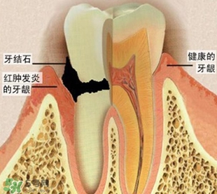 牙結(jié)石是什么？牙結(jié)石圖片