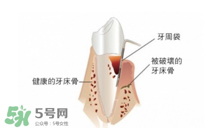 牙周炎怎么治療？牙周炎怎么治好