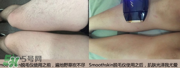 smoothskin和slikn infinity哪個(gè)好？smoothskin脫毛儀怎么樣