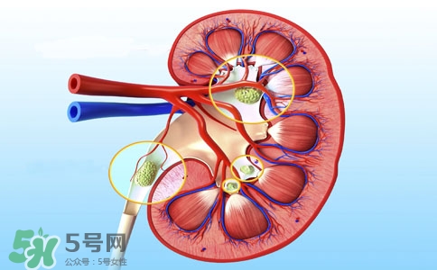 腎結(jié)石有什么癥狀？腎結(jié)石原因