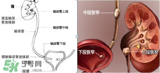 腎結(jié)石怎么治最好？腎結(jié)石的醫(yī)治方法