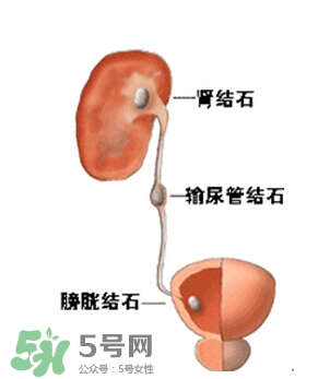 腎結(jié)石有什么癥狀？腎結(jié)石原因