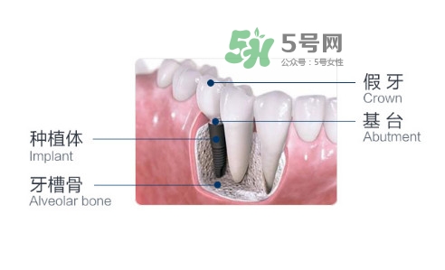 種植牙費(fèi)用多少錢？國(guó)產(chǎn)種植牙價(jià)格