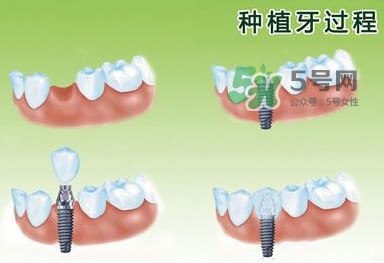 種植牙費(fèi)用多少錢？國(guó)產(chǎn)種植牙價(jià)格