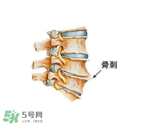 骨刺是怎么形成的？骨刺怎么治療？