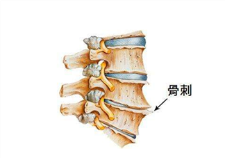 骨刺是怎么形成的？骨刺怎么治療？