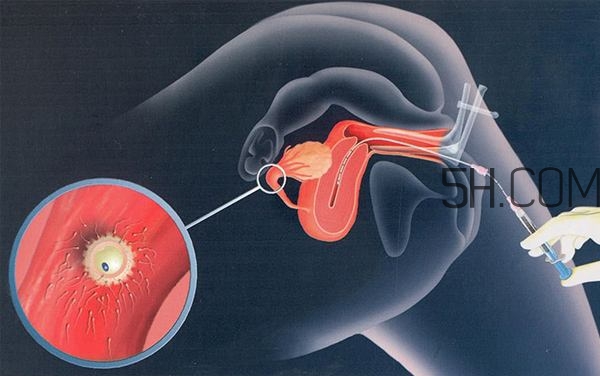 人工授精取卵子怎么?。咳斯な诰腥嗽鯓尤【?？