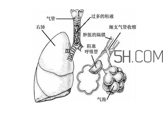 哮喘是怎么引起的?哮喘是什么感覺(jué)?