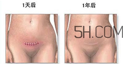 什么情況下需要剖腹產(chǎn) 剖腹產(chǎn)最全科普