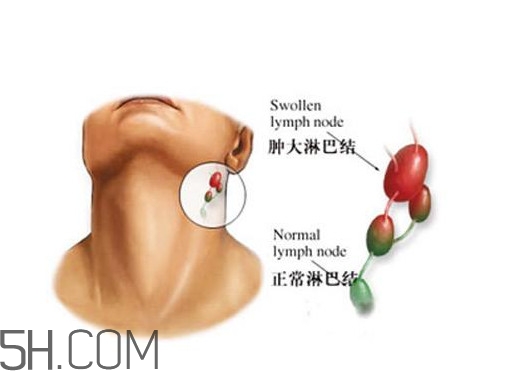 淋巴癌能活多久？淋巴癌癥狀有哪些