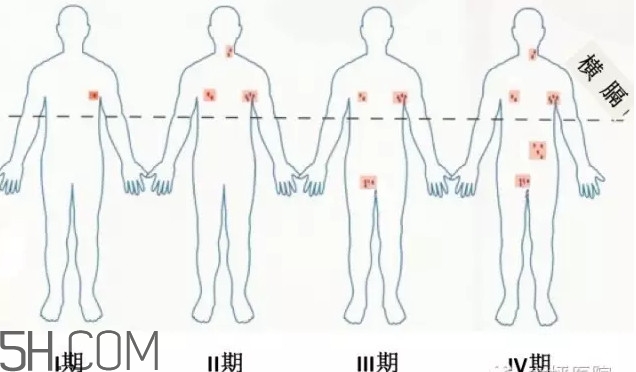 淋巴癌是怎么回事？淋巴癌如何診斷