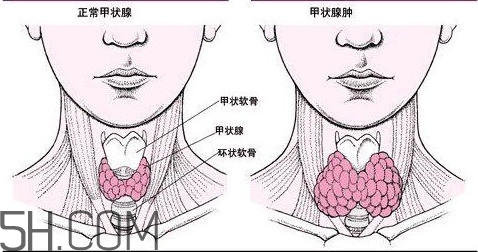 甲狀腺結(jié)節(jié)與甲狀腺腫瘤的區(qū)別有哪些？甲狀腺結(jié)節(jié)可以艾灸嗎