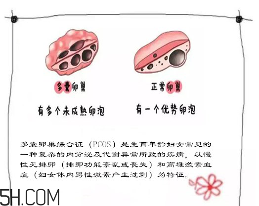 多囊卵巢生不了？多囊卵巢懷孕要看準(zhǔn)時間