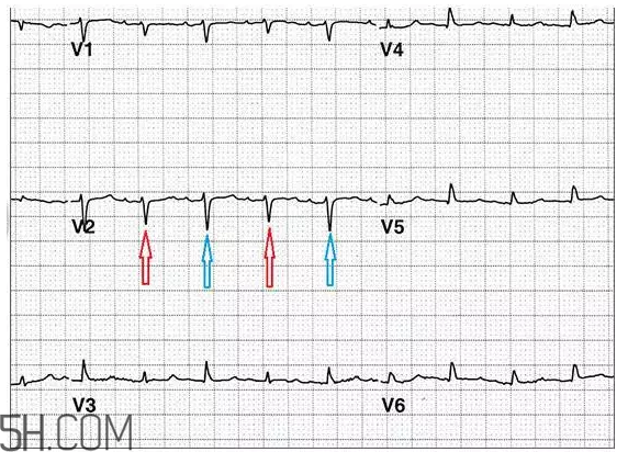心電圖怎么看？6種常見心電圖異常情況