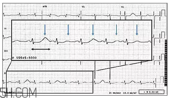 心電圖怎么看？6種常見心電圖異常情況