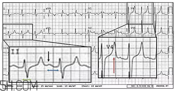 心電圖怎么看？6種常見心電圖異常情況