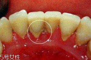 牙結(jié)石能自動脫落嗎？除了洗牙別無他法