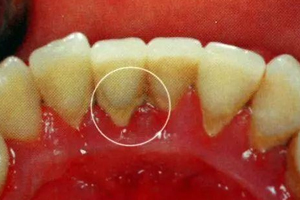 牙結(jié)石能自動(dòng)脫落嗎？除了洗牙別無(wú)他法