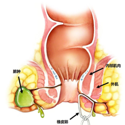 肛瘺非手術(shù)治療才可以嗎？手術(shù)是治療的關(guān)鍵途徑