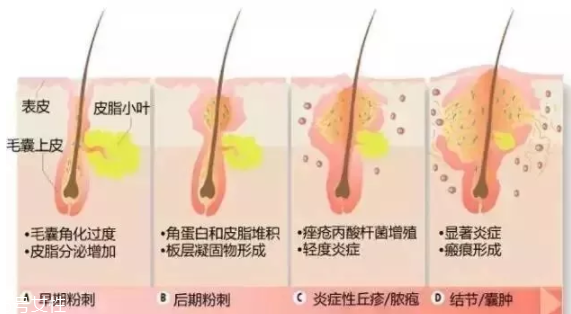 封閉性粉刺的發(fā)病機(jī)制是什么？角質(zhì)層太厚