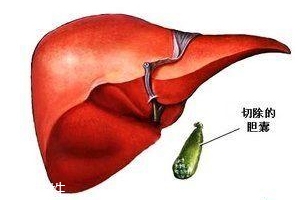 膽囊為什么容易長結石？與個體因素密切相關