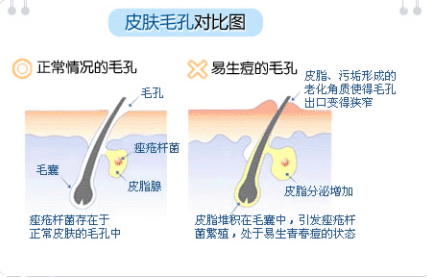 臉上長痘痘怎么快速去除 如何一天之內(nèi)消除痘痘