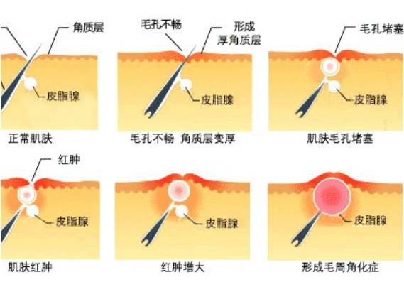 臉上有雞皮膚怎么消除 臉上雞皮膚怎么消除