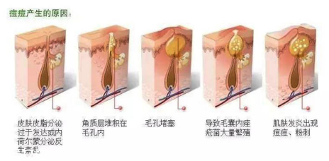 頑固痘痘怎么消除？油皮為什么反復(fù)爆痘？