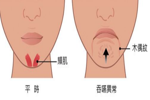 木偶紋怎么消除 讓你笑起來更自信