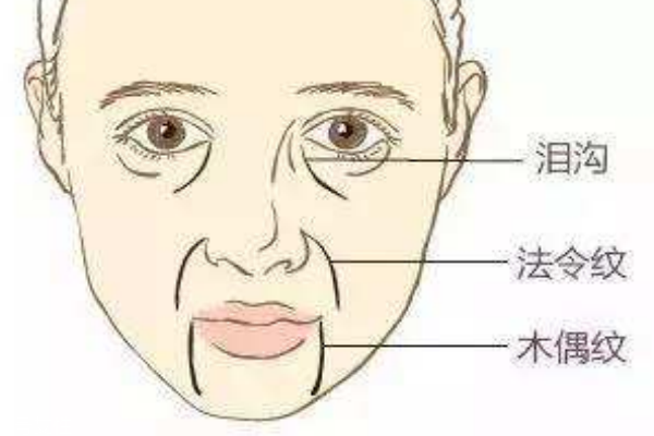 木偶紋怎么消除 讓你笑起來更自信