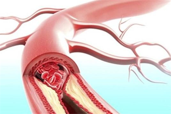 動脈粥樣硬化的原因與預(yù)防