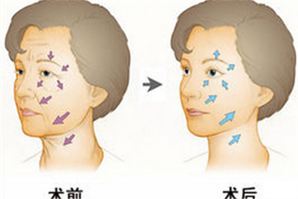 打除皺針的最佳時間是什么 什么時候打除皺針好