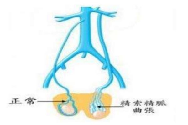 什么是經(jīng)脈曲張 將脈曲張的危害是什么