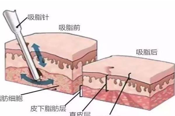 水動力吸脂的工作原理是什么呢 水動力吸脂多少錢一次呢