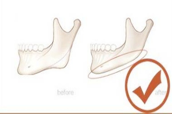什么人適合下頜角整形手術 下頜角整形手術多久能消腫