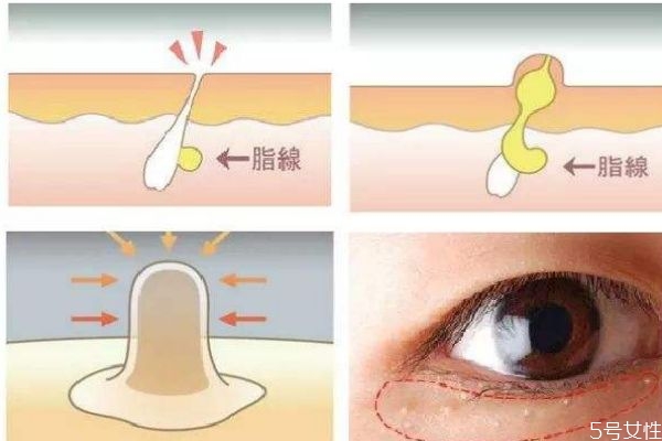 脂肪粒是怎么形成的呢 脂肪?？梢宰约汉脝?></p><h3>脂肪?？梢宰约汉脝?/h3><p>很多人都有長脂肪粒的煩惱，但是卻并不是所有長脂肪粒的人都知道要怎么去去除它們，還有很多女生覺得，脂肪粒長了就長了，沒必要去搭理它們，過段時(shí)間之后皮膚就會自動(dòng)的把它們的消滅了。雖說，我們每一個(gè)人的皮膚確實(shí)有自我修復(fù)的作用，有一部分脂肪粒也確實(shí)可以在一定的時(shí)間內(nèi)被我們自身的調(diào)節(jié)機(jī)制去除，但是大部分人長的脂肪粒，并不會在時(shí)光里被治愈，而是在漫長的歲月里，一直停留在你臉上，為你的形象減分。</p><p style=